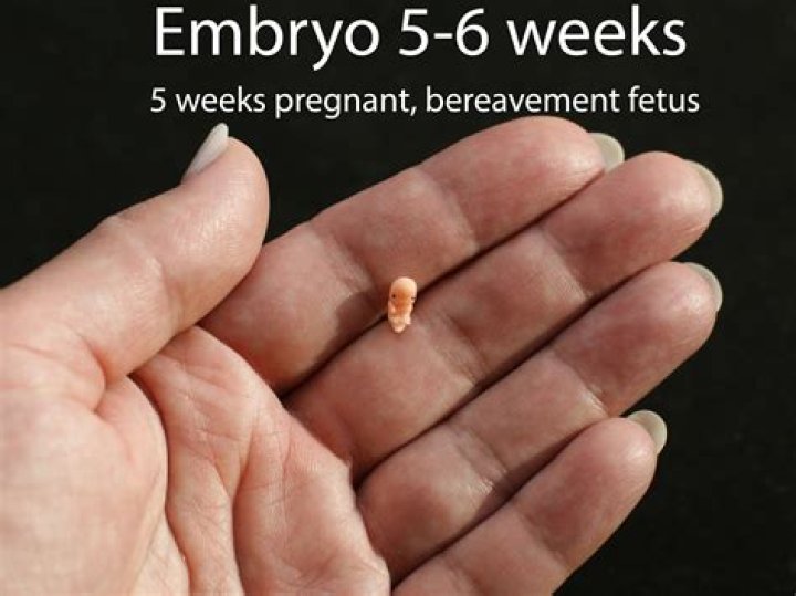 Understanding Miscarriage Tissue Pictures at 6 Weeks: A Comprehensive Guide